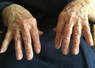 Ζώντας με την νόσο Πάρκινσον (Parkinson)