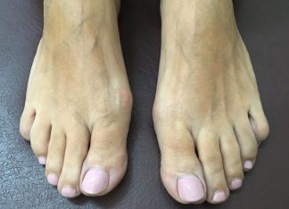 Βλαισοί Mεγαδάκτυλοι (κότσια): Τι πρέπει να γνωρίζω;