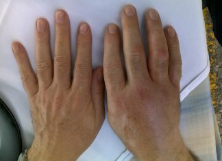 Ουρικό Οξύ: Τι πρέπει να γνωρίζω και τι να προσέχω;