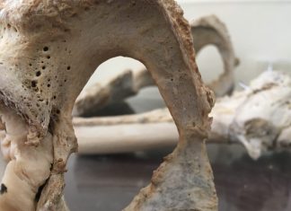 Ατελής Οστεογένεση