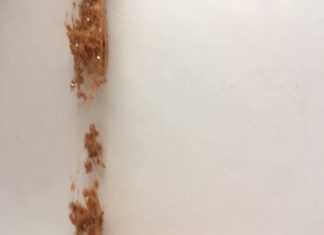 Ινώδης δυσπλασία/σύνδρομο McCune- Albright