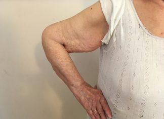 Σαρκοπενία