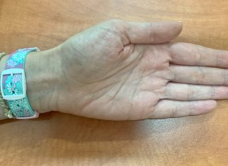 Σύνδρομο καρπιαίου σωλήνα