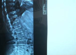 Οστεοπόρωση