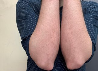 Κατά πλάκας ψωρίαση