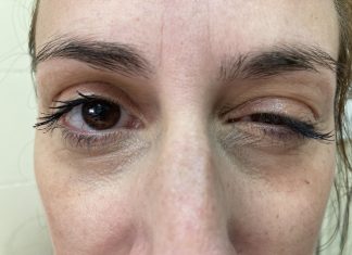 Μυασθένεια Gravis