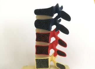 Οστεοπόρωση και οσφυαλγία