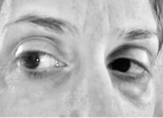 Βλεφαροπλαστική