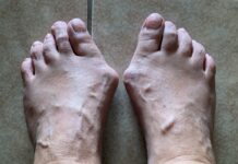 Κάλοι και κότσια: ένα πρόβλημα όχι μόνο αισθητικό!