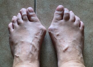 Κάλοι και κότσια: ένα πρόβλημα όχι μόνο αισθητικό!