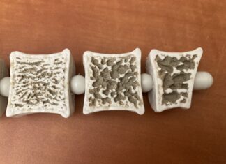 Λιπώδης ιστός και οστεοπόρωση