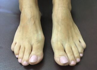 Επίκτητη Πλατυποδία των ενηλίκων