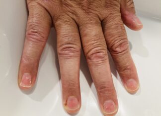 Μυοσκελετικά άλγη και βλάβες στα νύχια