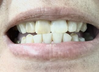 Έγκλειστα δόντια-Δόντια που δεν μπορούν να ανατείλουν στο στόμα (έγκλειστοι)