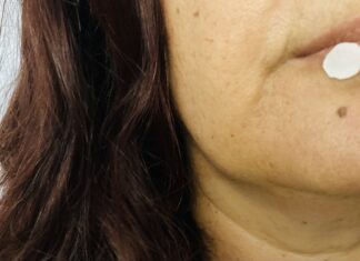 Άφθες, οι γνωστές-άγνωστες