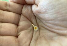 Genetics of osteoporosis.