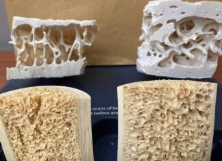 Οστεοπόρωση και χαμηλό σωματικό βάρος