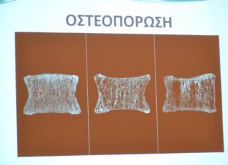 Δευτεροπαθής Οστεοπόρωση