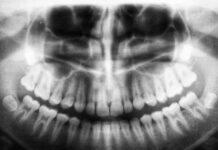 Osteoporosis and jaw