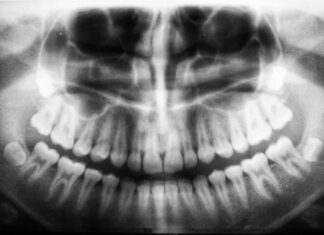Osteoporosis and jaw
