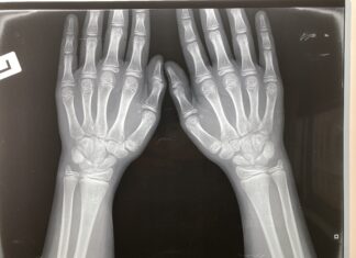 Χ-ΦΥΛΟΣΥΝΔΕΤΗ ΥΠΟΦΩΣΦΟΡΑΙΜΙΚΗ ΡΑΧΙΤΙΔΑ/ΟΣΤΕΟΜΑΛΑΚΥΝΣΗ