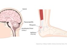 Σύνδρομο Costello
